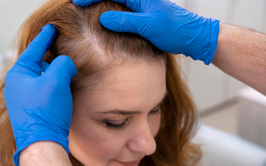 Does Platelet-Rich Plasma Therapy Work for Hair Loss?